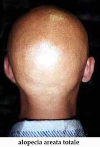 Alopecia Areata