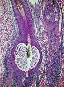 Follicolite Decalvante